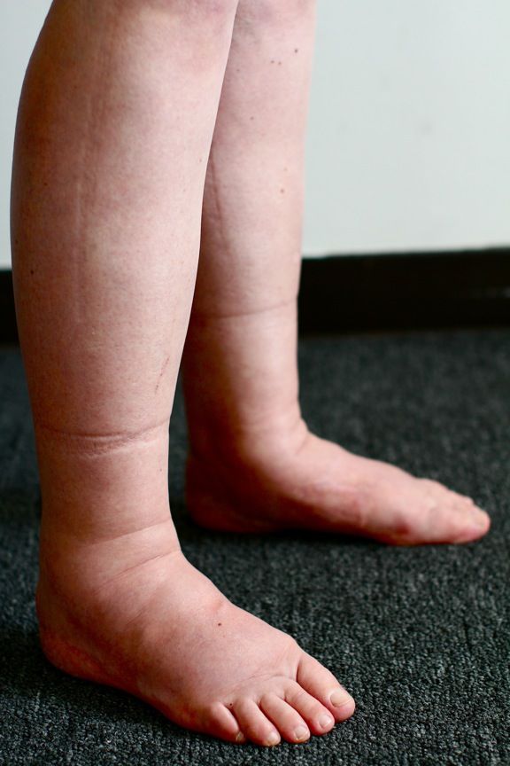Lipedema